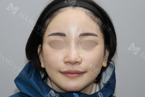 눈 after이미지